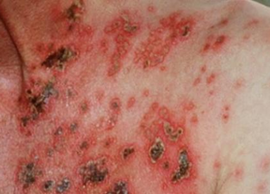 متحور جديد لفيروس الإيدز HIV